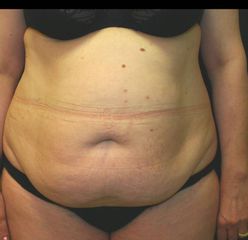 Lipo addome pre