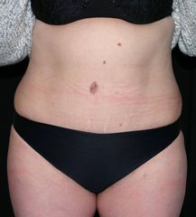 Lipo addome post