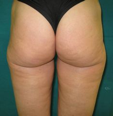 Laser lipolisi gluteo pre