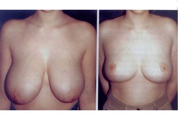 Mastoplastica riduttiva pre e post