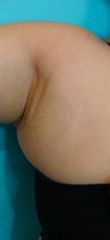 Lipo sotto braccio pre