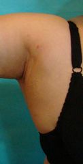 Lipo sotto braccio post