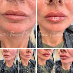 clinica piave russian lips