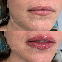 Filler labbra - Clinica Piave