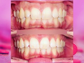 Sbiancamento denti - 825111