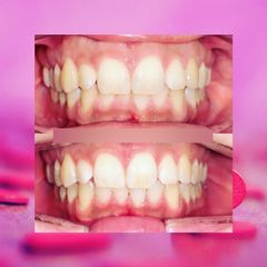 Sbiancamento denti - Clinica Piave