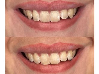 Sbiancamento denti - 838393