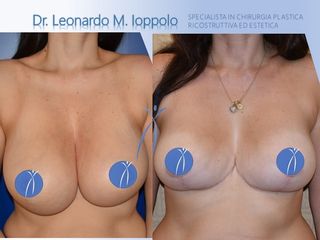 Mastoplastica additiva prima e dopo