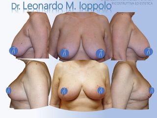 Mastoplastica riduttiva prima e dopo