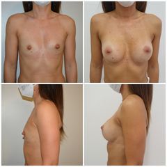 Mastoplastica additiva - Dr. Paolo Montemurro