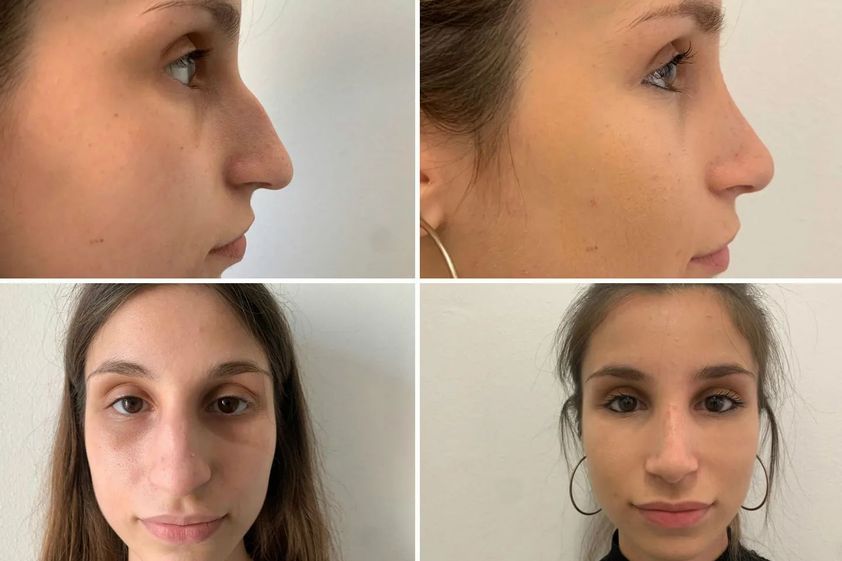 Rinoplastica prima e dopo - 865877