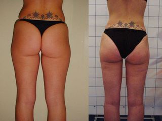 Liposuzione pre e post