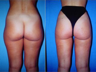 Liposuzione prima e dopo