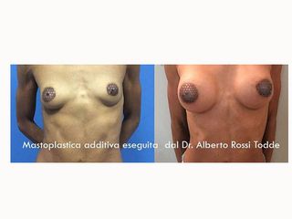 Mastoplastica additiva prima e dopo