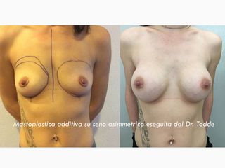 Mastoplastica additiva prima e dopo