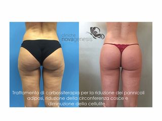 Carbossiterapia prima e dopo