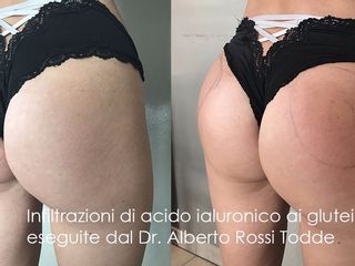 Acido ialuronico glutei prima e dopo