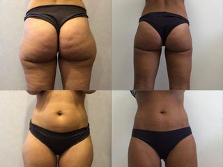 Liposcultura prima e dopo