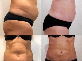 Liposcultura prima e dopo