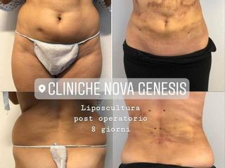 Liposcultura prima e dopo