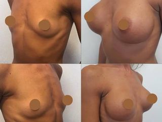 Mastoplastica additiva prima e dopo