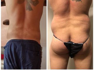 Liposcultura prima e dopo