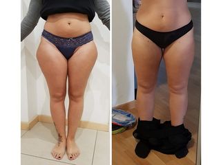 Liposuzione prima e dopo