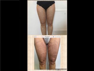 fractora gambe