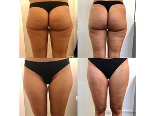 Cellulite prima e dopo