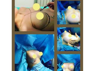 Mastoplastica additiva - Dott. Alberto Rossi Todde