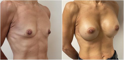 Mastoplastica additiva - Cliniche Novagenesis - dott. Alberto Rossi Todde