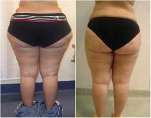 Liposuzione  - Cliniche Novagenesis - dott. Alberto Rossi Todde