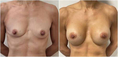 Mastoplastica additiva - Cliniche Novagenesis - dott. Alberto Rossi Todde