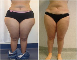 Liposuzione  - Cliniche Novagenesis - dott. Alberto Rossi Todde