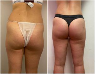 Liposuzione  - Cliniche Novagenesis - dott. Alberto Rossi Todde
