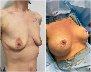 Mastoplastica additiva - Cliniche Novagenesis - dott. Alberto Rossi Todde