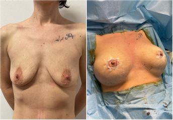 Mastoplastica additiva - Cliniche Novagenesis - dott. Alberto Rossi Todde