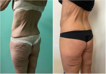 Liposuzione  - Cliniche Novagenesis - dott. Alberto Rossi Todde