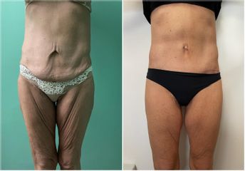 Liposuzione  - Cliniche Novagenesis - dott. Alberto Rossi Todde