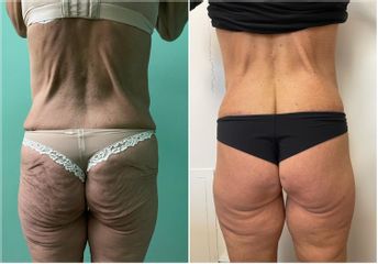 Liposuzione  - Cliniche Novagenesis - dott. Alberto Rossi Todde