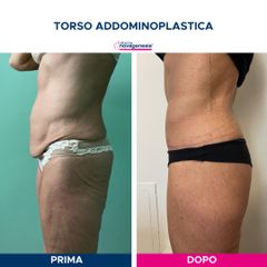 Addominoplastica - Cliniche Novagenesis - dott. Alberto Rossi Todde