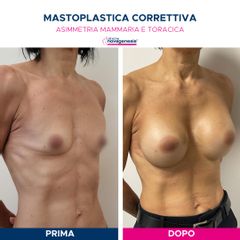Mastoplastica additiva - Cliniche Novagenesis - dott. Alberto Rossi Todde
