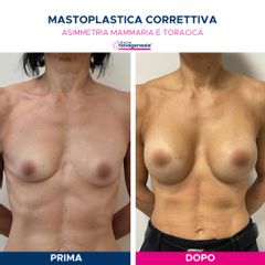 Mastoplastica additiva - Cliniche Novagenesis - dott. Alberto Rossi Todde