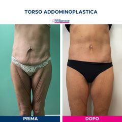 Addominoplastica - Cliniche Novagenesis - dott. Alberto Rossi Todde