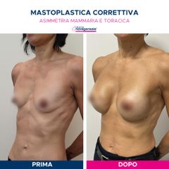 Mastoplastica additiva - Cliniche Novagenesis - dott. Alberto Rossi Todde