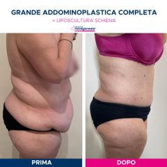 Addominoplastica - Cliniche Novagenesis - dott. Alberto Rossi Todde