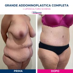 Addominoplastica - Cliniche Novagenesis - dott. Alberto Rossi Todde