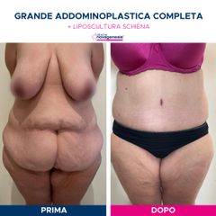 Addominoplastica - Cliniche Novagenesis - dott. Alberto Rossi Todde