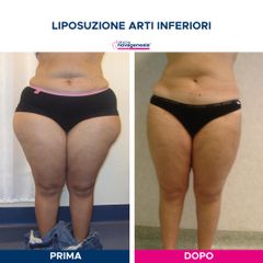 Liposuzione  - Cliniche Novagenesis - dott. Alberto Rossi Todde