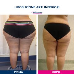 Liposuzione  - Cliniche Novagenesis - dott. Alberto Rossi Todde